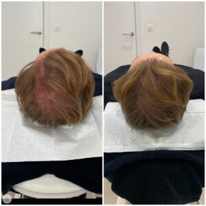 haarstimulatie man voor na