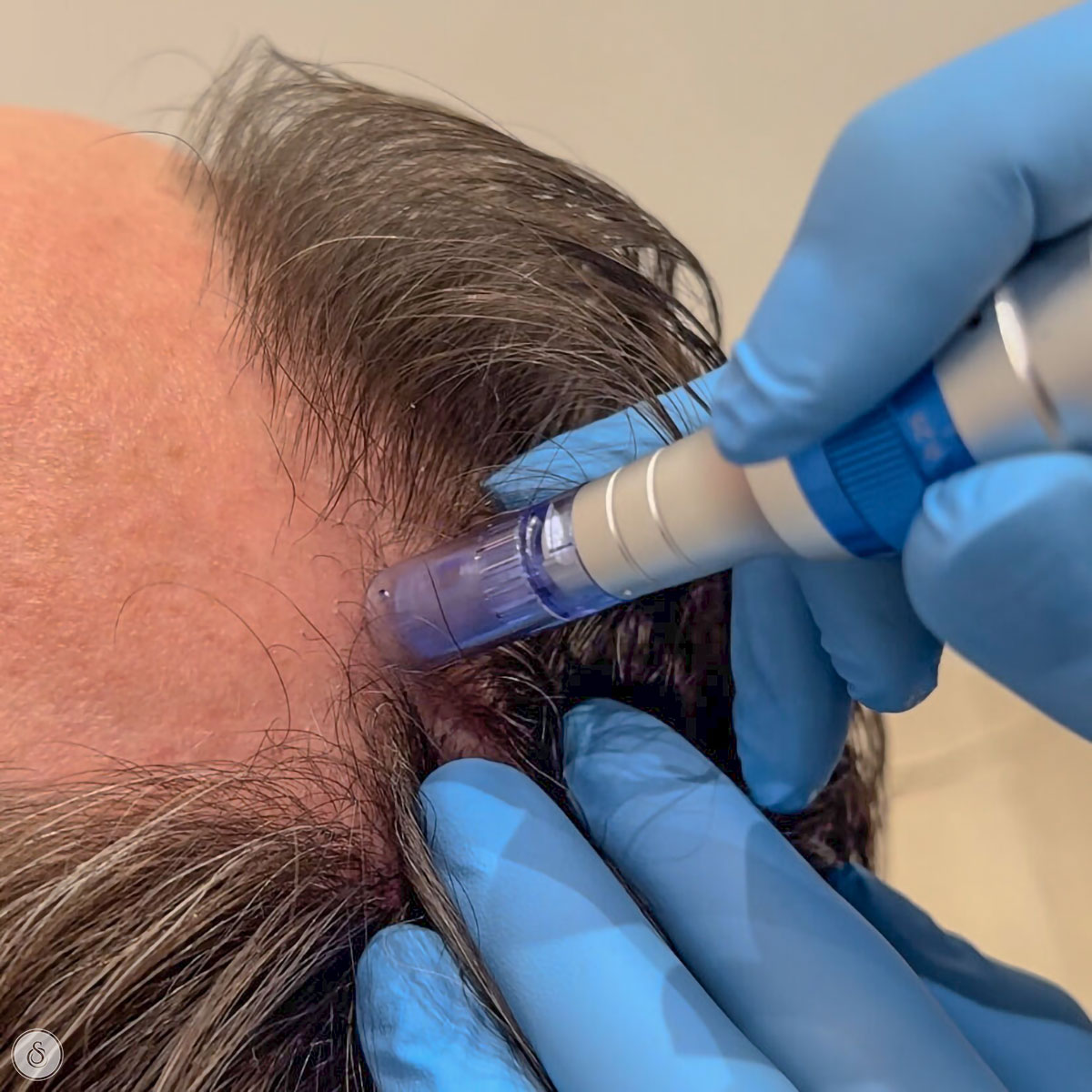 SarasinClinic_microneedling-hair haarstimulatie met microneedling hoofd man